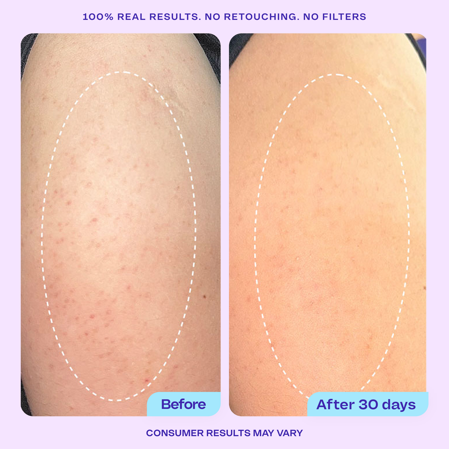 Side-by-side comparison showing close-up skin texture. “Before” image shows visible redness and bumps, while the “After” image shows smoother, more even-toned skin. Text reads: “100% real results. No retouching. No filters.” and “Consumer results may vary.”