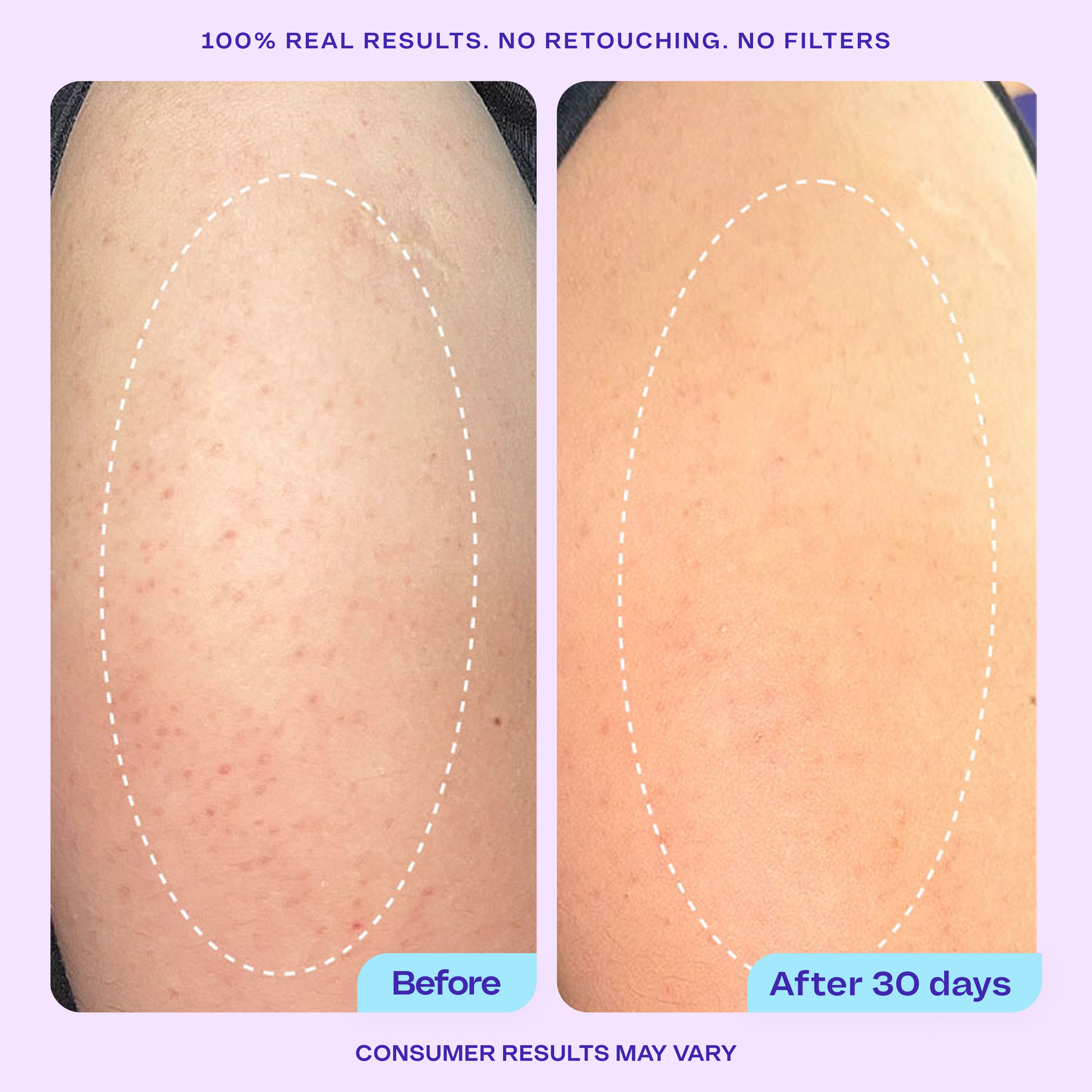 Side-by-side comparison showing close-up skin texture. “Before” image shows visible redness and bumps, while the “After” image shows smoother, more even-toned skin. Text reads: “100% real results. No retouching. No filters.” and “Consumer results may vary.”