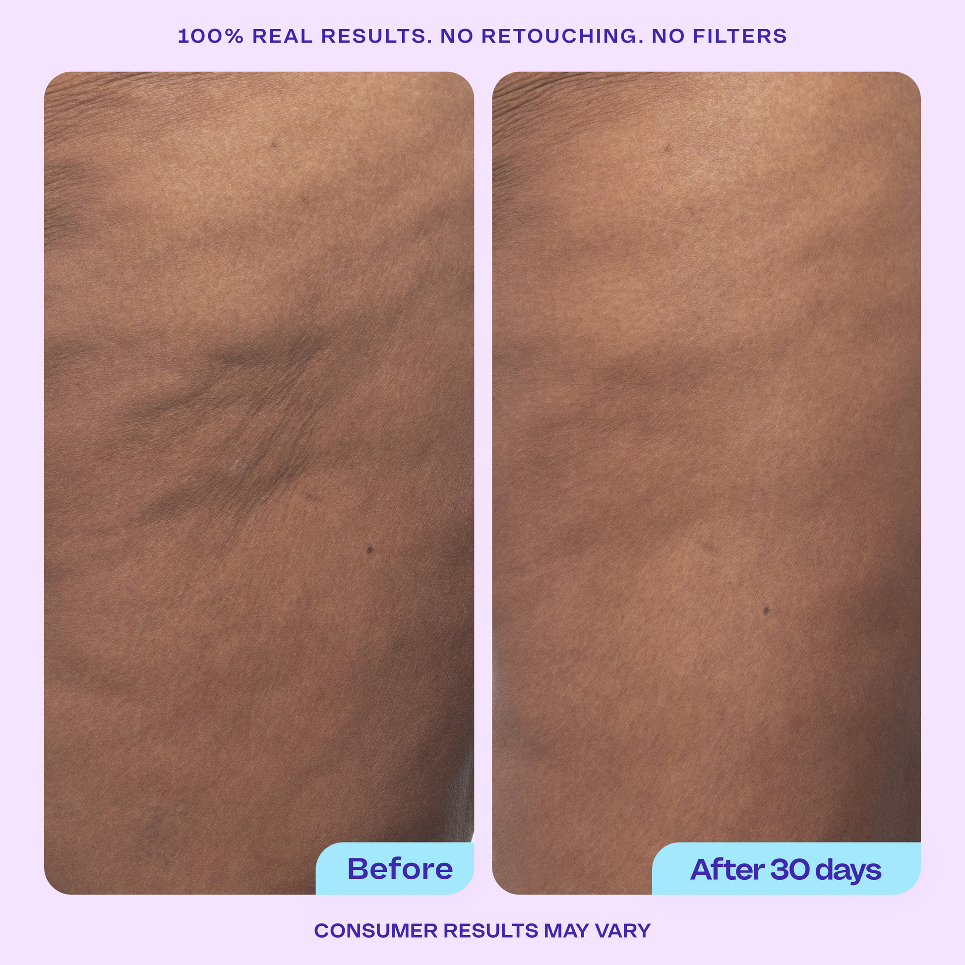 Side-by-side photos of skin texture labeled “Before” and “After 30 days.” The “After” image shows visibly smoother skin with reduced dimpling. Text above says “100% real results. No retouching. No filters,” and a note below reads “Consumer results may vary.”