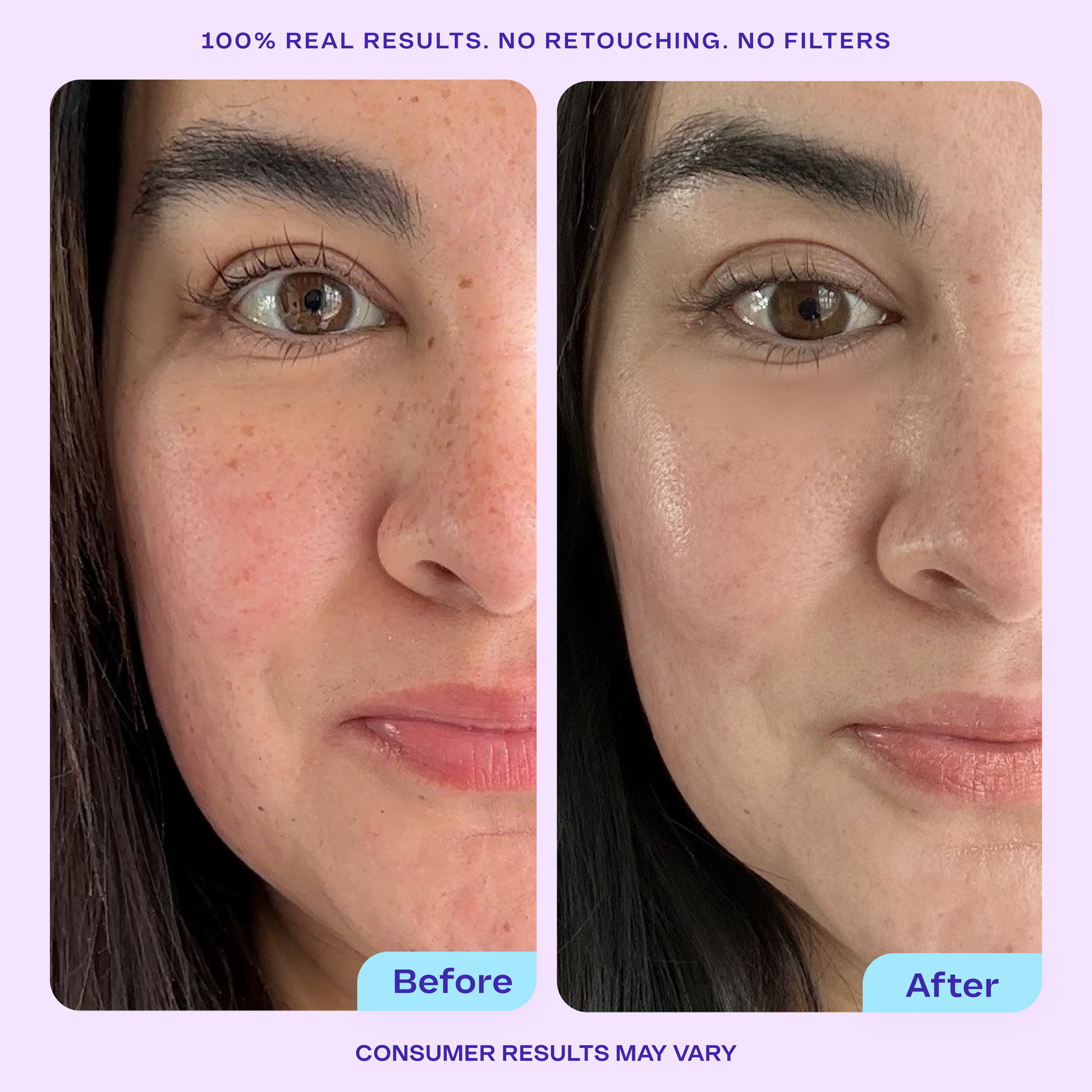 Side-by-side before and after comparison of a woman’s face showing visible skin improvement. The “Before” image shows some redness and uneven texture, while the “After” image shows smoother, more even, and hydrated skin. Text above reads “100% real results. No retouching. No filters,” and below reads “Consumer results may vary.”