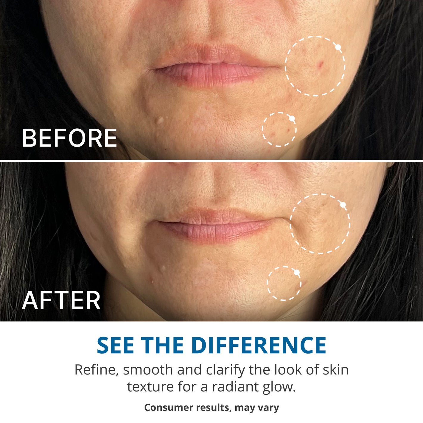Side-by-side comparison of a woman's lower face before and after using BHA for 4 weeks. The "before" image shows more visible redness and blemishes, while the "after" image shows clearer, smoother skin with reduced redness