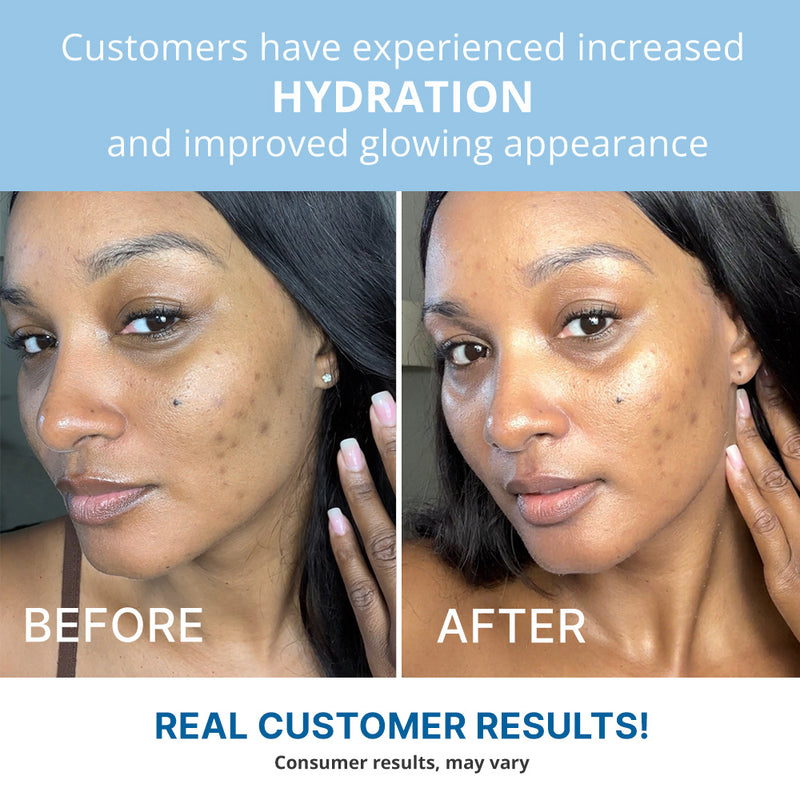  Before and after skincare results of a woman showing clearer complexion, after using SPF.