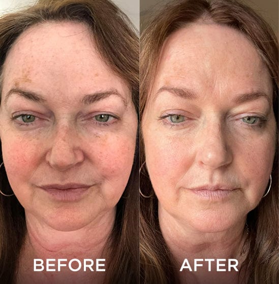 Before and after images of a woman showing reduced hyperpigmentation and redness after using a skincare product.