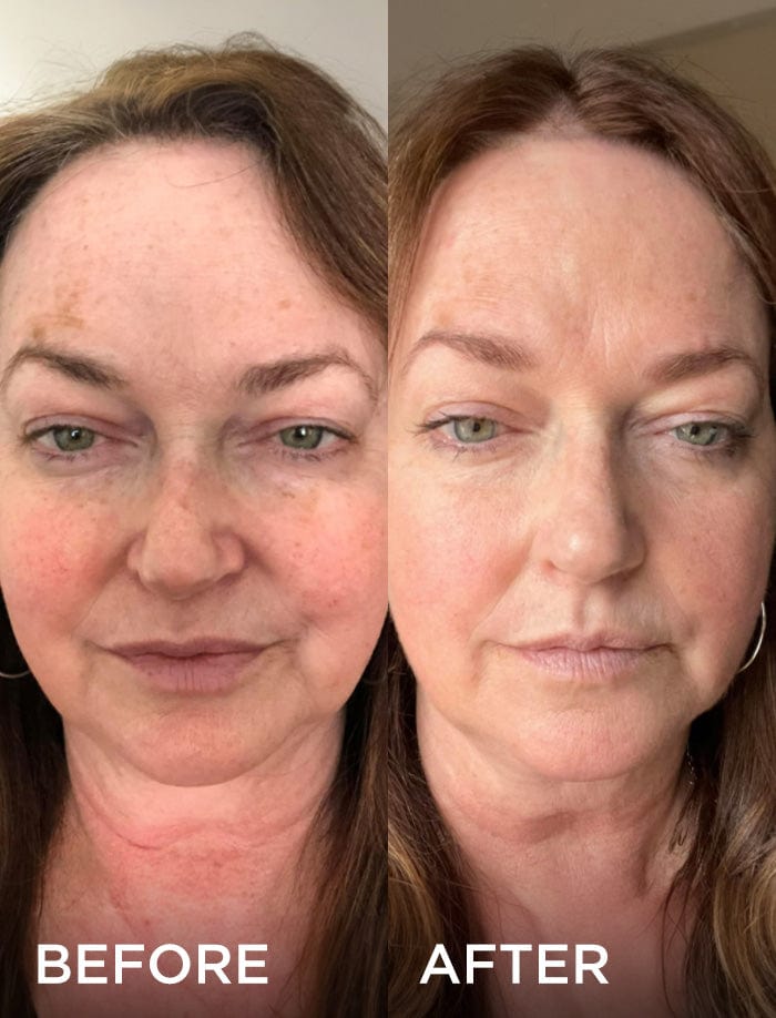 Before and after images of a woman showing reduced hyperpigmentation and redness after using a skincare product.