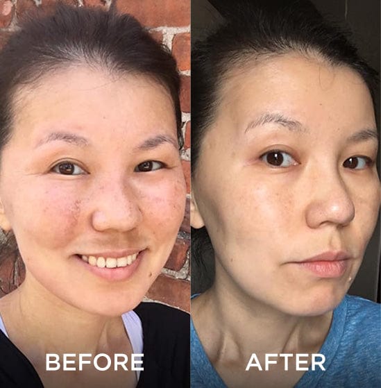 Side-by-side comparison of a woman’s face before and after using a skincare product. The “before” image shows her smiling with noticeable hyperpigmentation, while the “after” image shows a more even skin tone and fewer blemishes.
