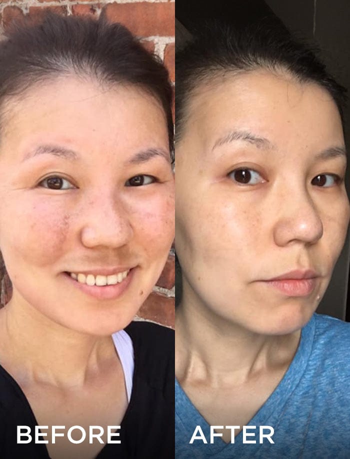 Side-by-side comparison of a woman’s face before and after using a skincare product. The “before” image shows her smiling with noticeable hyperpigmentation, while the “after” image shows a more even skin tone and fewer blemishes.