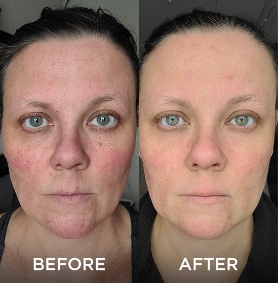 Side-by-side comparison of a woman's face before and after using a skincare product, showing significant improvement in skin texture and evenness.