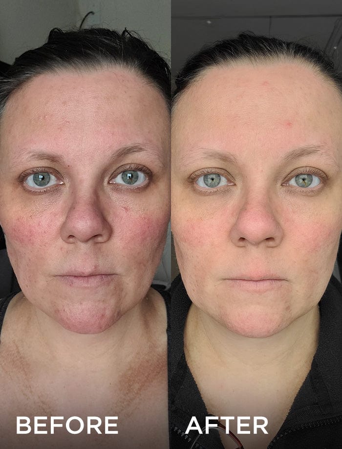 Side-by-side comparison of a woman's face before and after using a skincare product, showing significant improvement in skin texture and evenness.