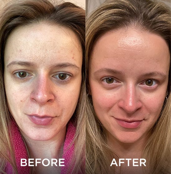 Side-by-side comparison of a woman's face before and after using a skincare product. The "before" image shows uneven skin tone and blemishes, while the "after" image shows smoother, clearer skin.