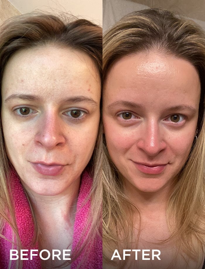 Side-by-side comparison of a woman's face before and after using a skincare product. The "before" image shows uneven skin tone and blemishes, while the "after" image shows smoother, clearer skin.